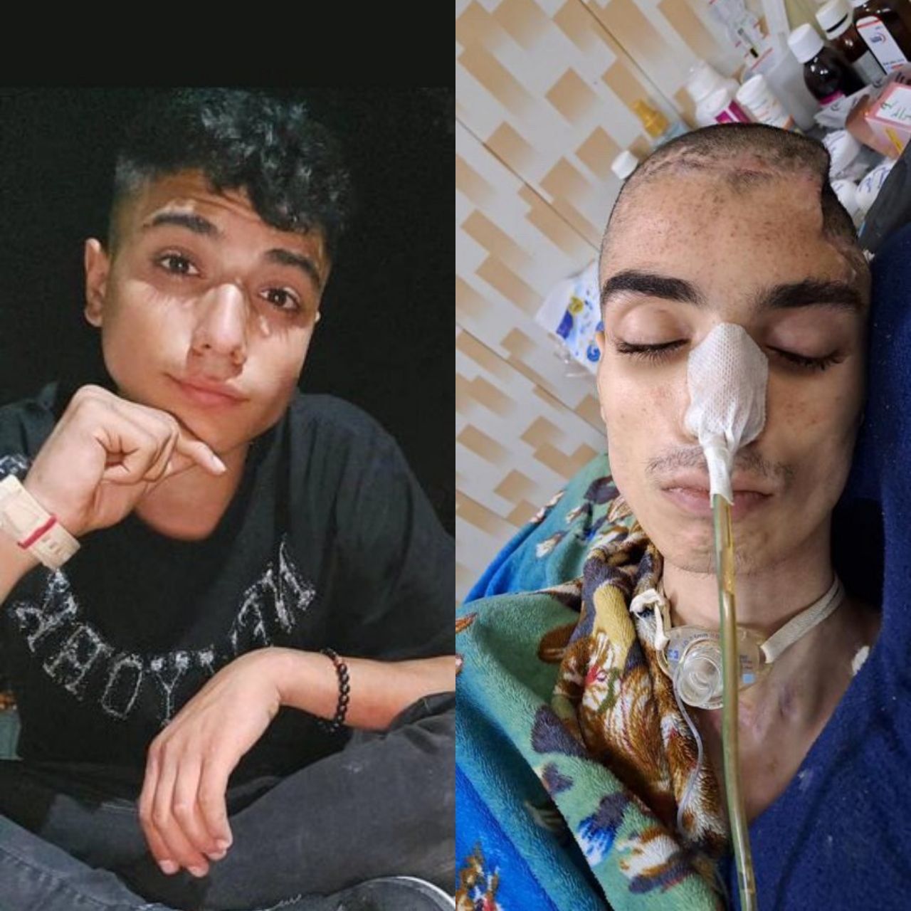 کودک دیگری قربانی شد؛ مرگ ابوالفضل امیرعطایی، هشت ماه پس از اصابت گلوله گاز اشک‌آور به سرش