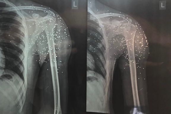 Sixteen-year-old protestor in Iran with multiple pellets in the left shoulder and few in the chest has lost the ability to move his arm due to permanent nerve injury. (Photo by Dr. Kayvan Mirhadi)