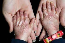 روزنامه شرق: قطعی آب و برق بیماران پروانه‌ای را در خطر قطع عضو قرار داده است