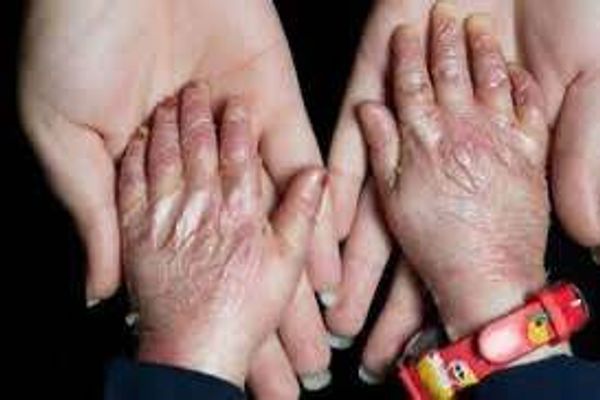 روزنامه شرق: قطعی آب و برق بیماران پروانهای را در خطر قطع عضو قرار داده است