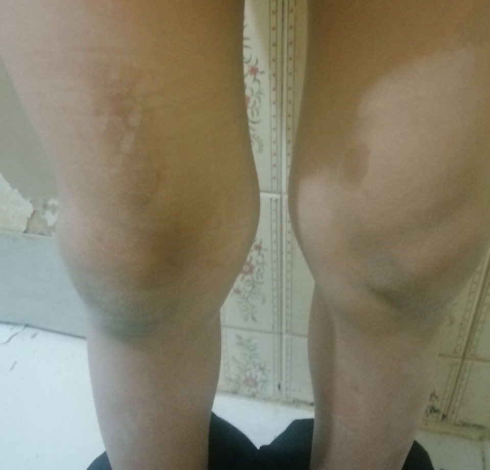 The kid who was burned by clothing-iron  (undated)