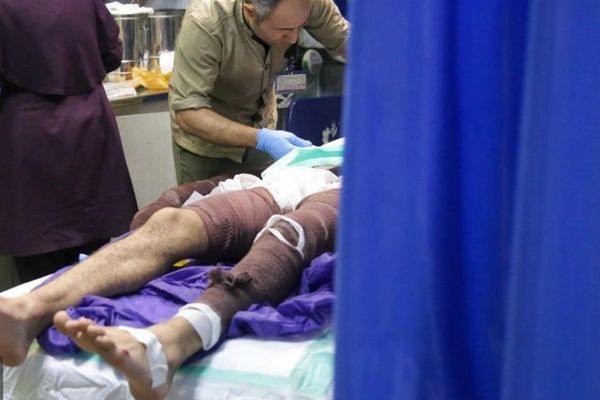 وزارت بهداشت: سالانه سه هزار نفر در ایران بر اثر سوختگی جان خود را از دست میدهند