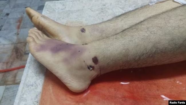 This photo shows the injuries and bruises on Peyman Galvani's legs.   (July 2023)