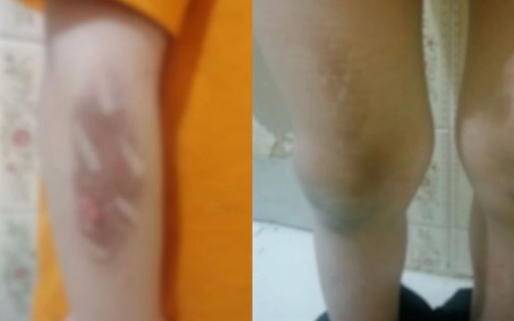 گزارش روزنامه اعتماد؛ بهعلت شب ادراری، دست و پای یک کودک را در مرکز نگهداری سوزاندند