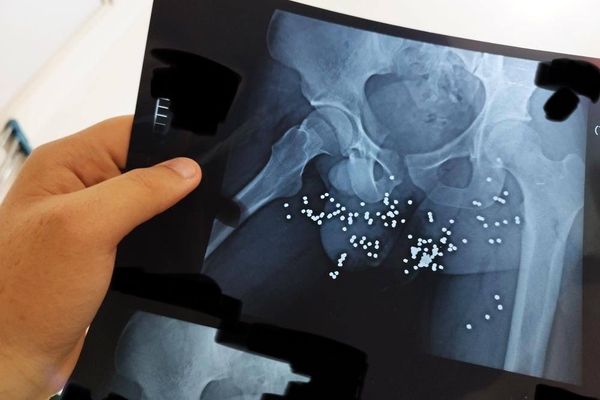 Shocking Images Of Wounded Iran Protesters Expose Regime Brutality