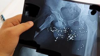 Shocking Images Of Wounded Iran Protesters Expose Regime Brutality