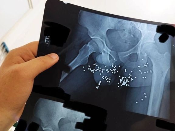 An x-ray image showing the genitals of a protester targeted shotgun pellets
