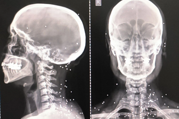 گزارش گاردین از هدفگیری عمدی اعضای حیاتی بدن برای سرکوب معترضان در ایران