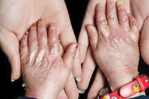 رییس هیات مدیره بنیاد بیماران نادر: بانک اطلاعات جامعی از بیماران نادر در دسترس نیست