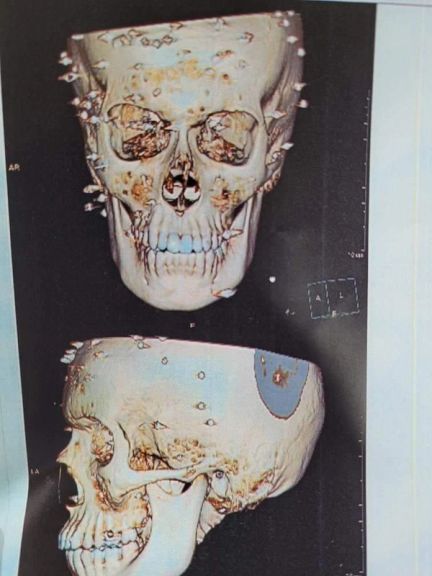 An MRI image showing the pellets in the head of a protester