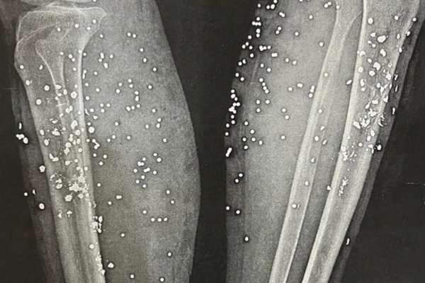 They carry the evidence of Iran’s crackdown on their bodies