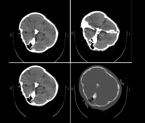 Mahsa Amini's CT scan obtained by Iran International shows her head trauma that killed her. FILE PHOTO