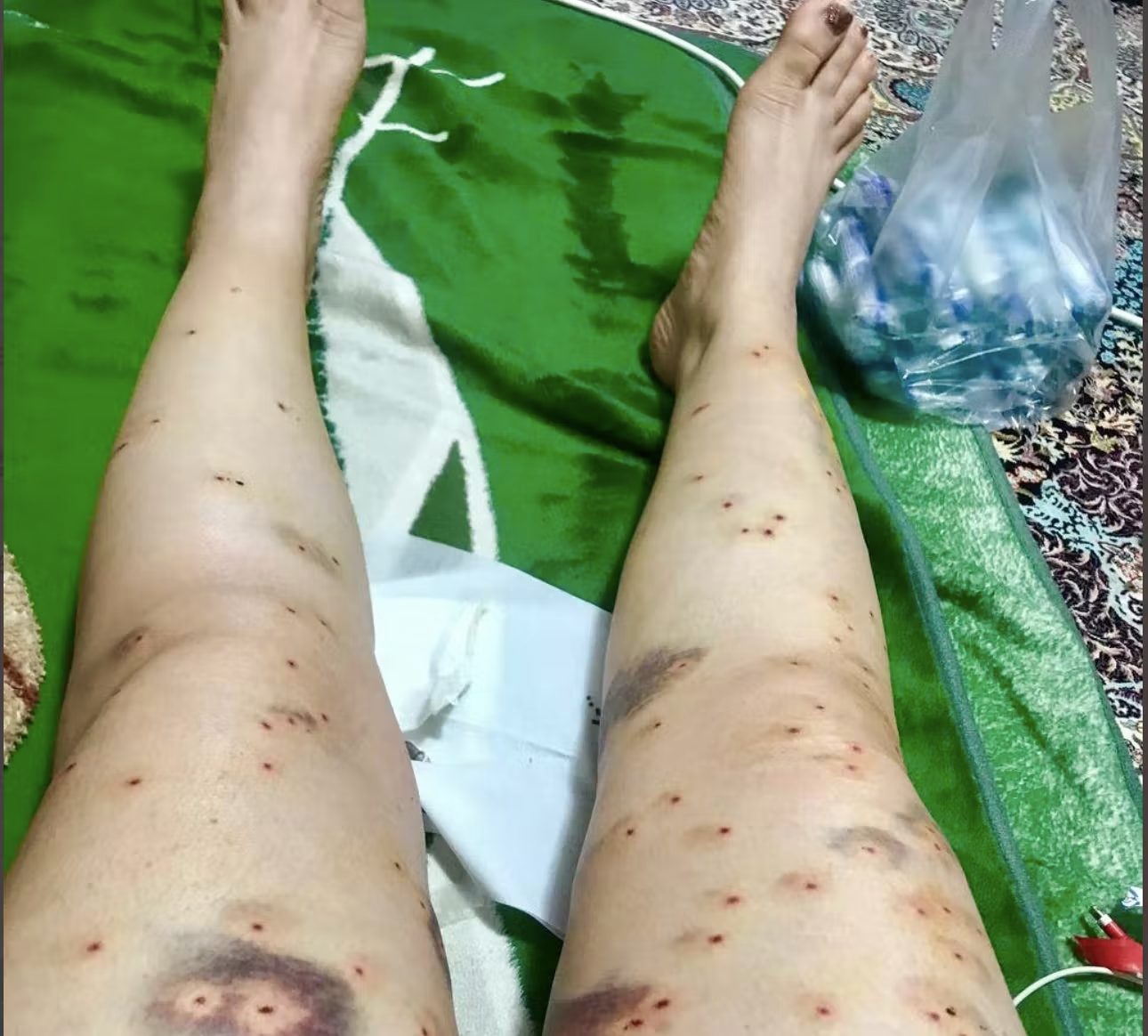 زخم ناسور بر تن رنجور زنانگی؛ گزارش گاردین از شلیک به صورت و اندام جنسی زنان معترض ایران