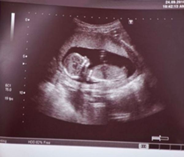 رییس انجمن علمی ژنتیک پزشکی ایران: واردات و تولید کیت‌های غربالگری ممنوع شده است