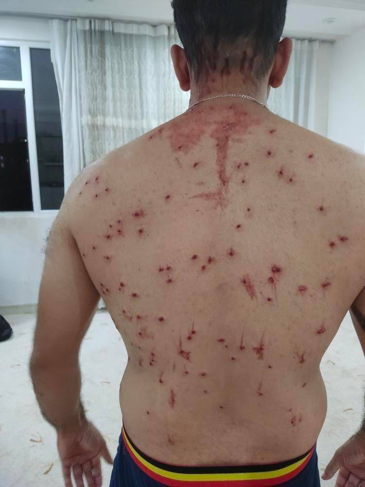 A man shot with 'birdshots' from a shotgun in Ilam on Septemebr 20, 2022