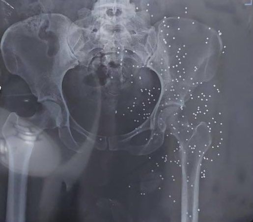 An x-ray image showing the genitals of a protester targeted by shotgun  