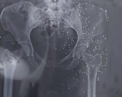 An x-ray image showing the genitals of a protester targeted by shotgun