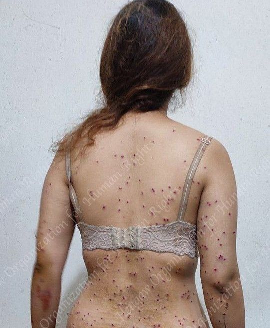 A woman who was shot during protests by 'birdshots' fired from a police shotgun. October 2022