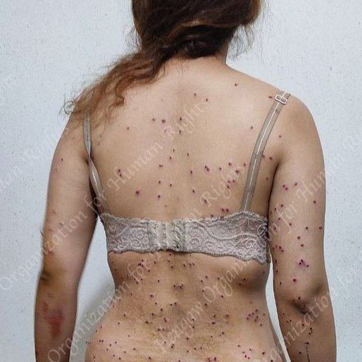 A woman targeted by shotgun 'birdshots' during protests in October