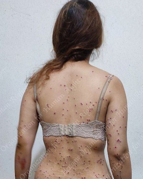 An Iranian woman shot by 'bird shots' fired by security forces from a shotgun had 187 pellets in her body
