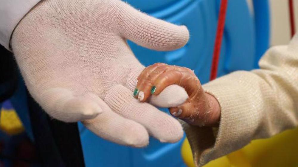 قطعی‌های مکرر آب و برق به تهدیدی مرگبار برای بیماران پروانه‌ای تبدیل شده است