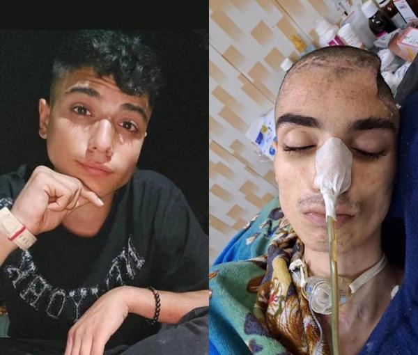 Iranian Teenager Shot In Head During Protests Succumbs To Injuries