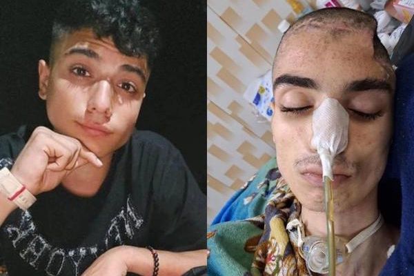 Iranian Teenager Shot In Head During Protests Succumbs To Injuries