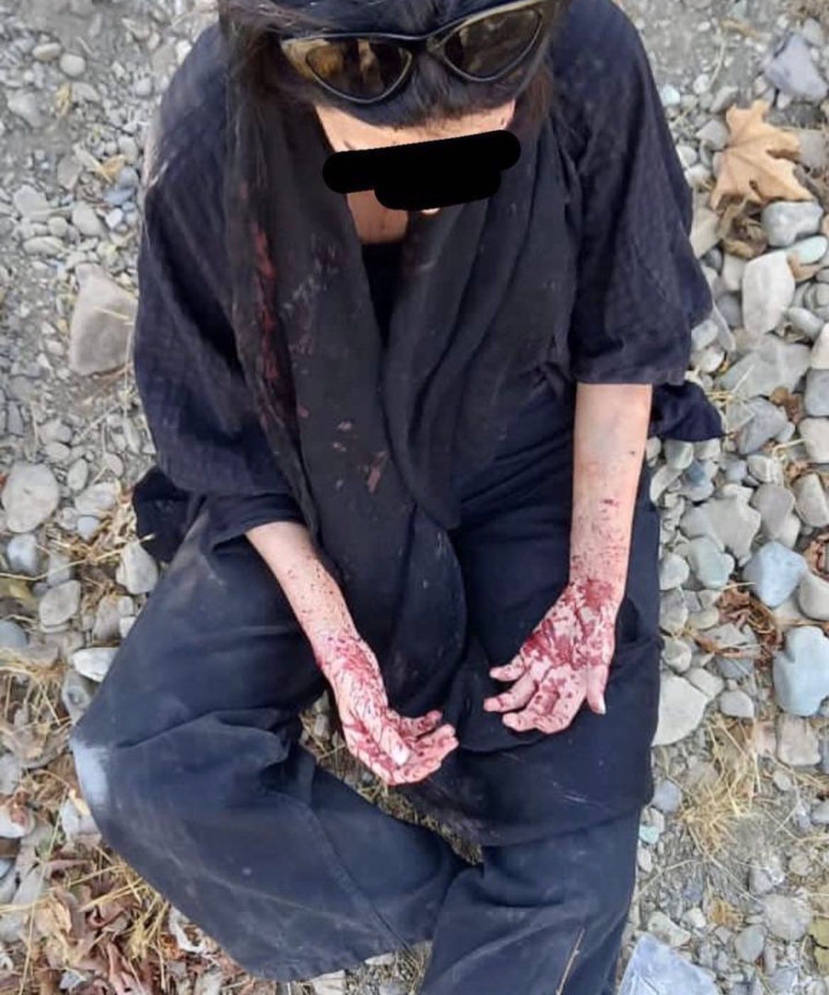 A protester hit in the hands by a shotgun "birdshot"