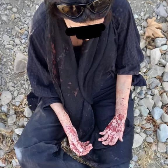 A protester hit in the hands by a shotgun "birdshot"